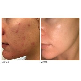 Alpha Beta® - Peeling Quotidien Formule Intense