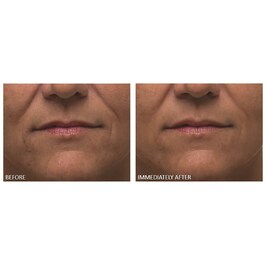 Alpha Beta® - Ultramildes Peeling für den Alltag