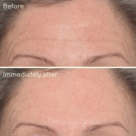 Resurgence, Targeted Wrinkle Corrector