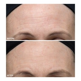 Alpha Beta® - Ultramildes Peeling für den Alltag