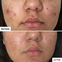 CENTELLA ACNE CARE - BERUHIGENDES FLUIDE